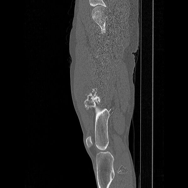 File:Chondrosarcoma arising from exostosis (Radiopaedia 59996-67507 Sagittal bone window 8).jpg