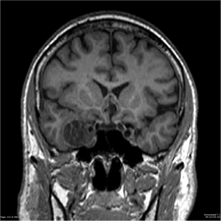Chondrosarcoma of skull base- grade II (Radiopaedia 40948-43654 Coronal T1 43).jpg