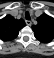 Chordoma (C4 vertebra) (Radiopaedia 47561-52188 Axial non-contrast 51).png
