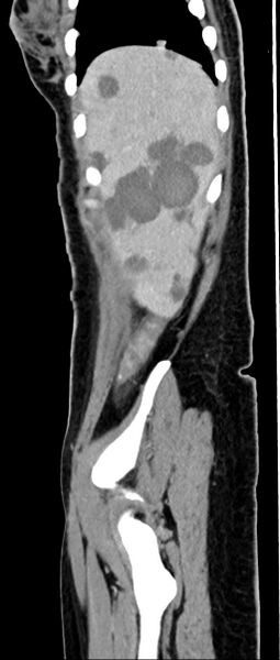 File:Choriocarcinoma liver metastases (Radiopaedia 74768-85766 C 146).jpg