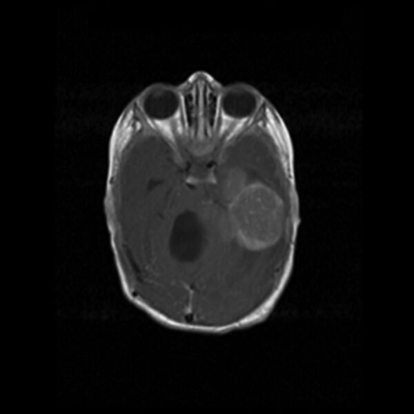 File:Choroid plexus carcinoma (Radiopaedia 21121-21035 Axial T1 C+ 7).jpg