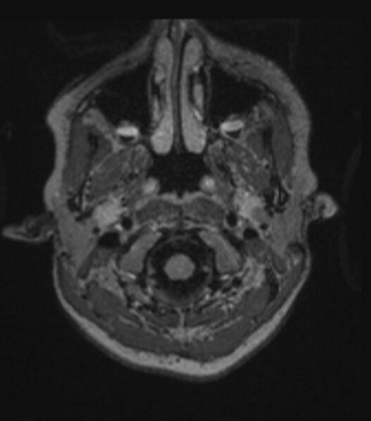 File:Choroid plexus carcinoma (Radiopaedia 91013-108553 Axial FLAIR C+ 72).jpg