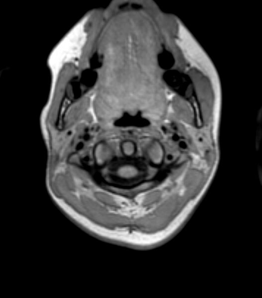 File:Choroid plexus carcinoma (Radiopaedia 91013-108553 Axial T1 10).jpg