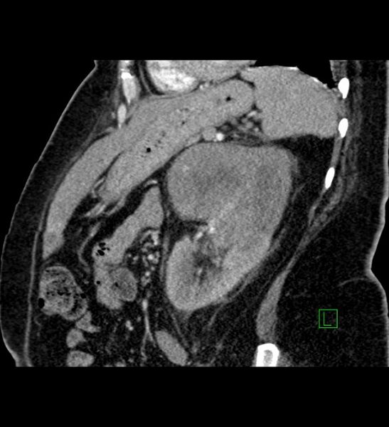 File:Chromophobe renal cell carcinoma (Radiopaedia 84239-99519 D 39).jpg