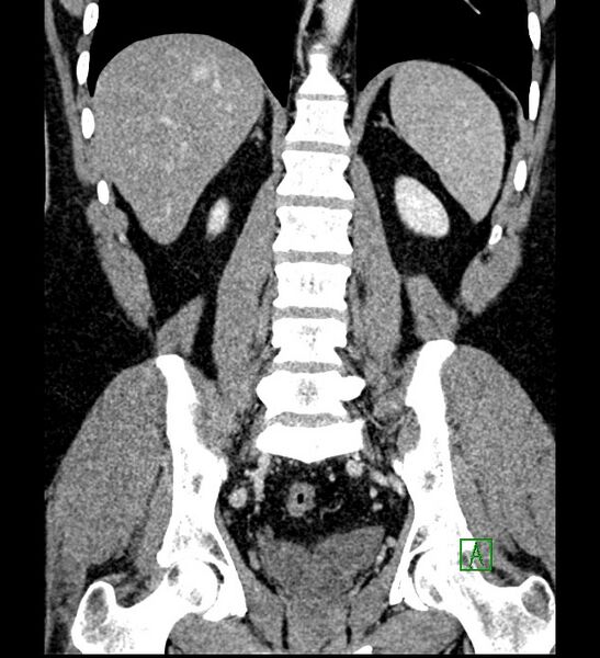 File:Chromophobe renal cell carcinoma (Radiopaedia 84286-99573 H 125).jpg