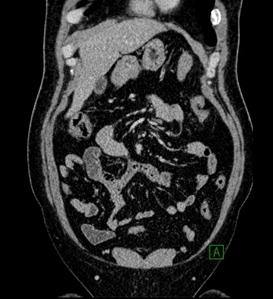 File:Chromophobe renal cell carcinoma (Radiopaedia 84286-99573 H 48).jpg