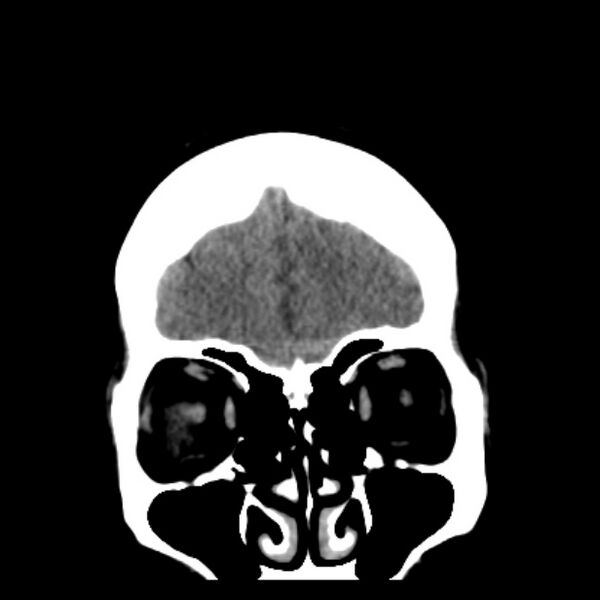 File:Chronic bilateral occipital lobe infarcts (Radiopaedia 31276-31996 Coronal non-contrast 10).jpg
