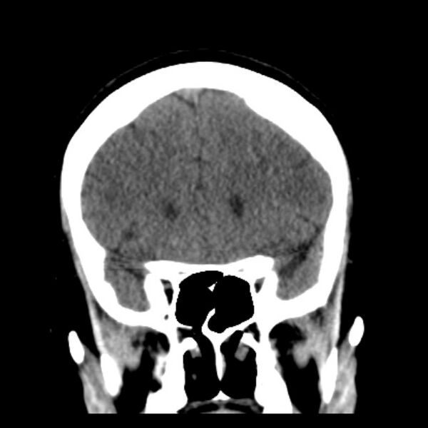 File:Chronic bilateral occipital lobe infarcts (Radiopaedia 31276-31996 Coronal non-contrast 17).jpg