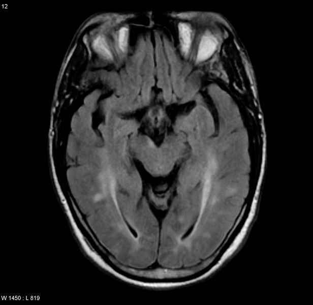 File:Chronic hypertensive encephalopathy (Radiopaedia 4564-6686 Axial FLAIR 5).jpg