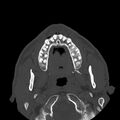 Chronic maxillary sinusitis (Radiopaedia 32524).jpg
