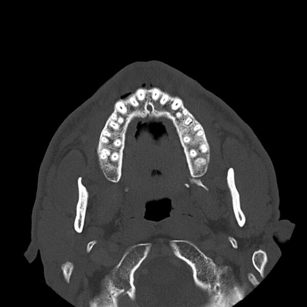 File:Chronic maxillary sinusitis (Radiopaedia 32524).jpg