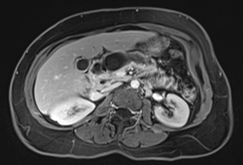 File:Chronic pancreatitis - pancreatic duct calculi (Radiopaedia 71818-82250 Axial T1 C+ fat sat 33).jpg