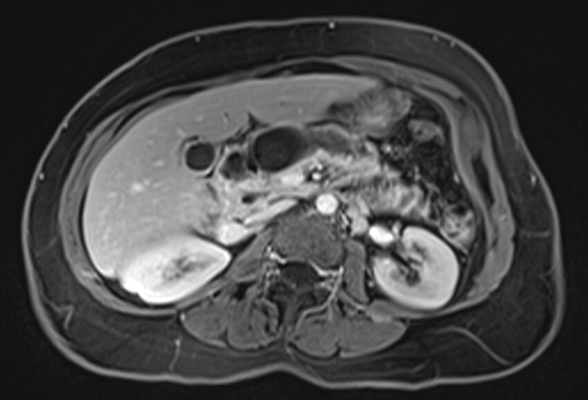 Chronic pancreatitis - pancreatic duct calculi (Radiopaedia 71818-82250 Axial T1 C+ fat sat 33).jpg