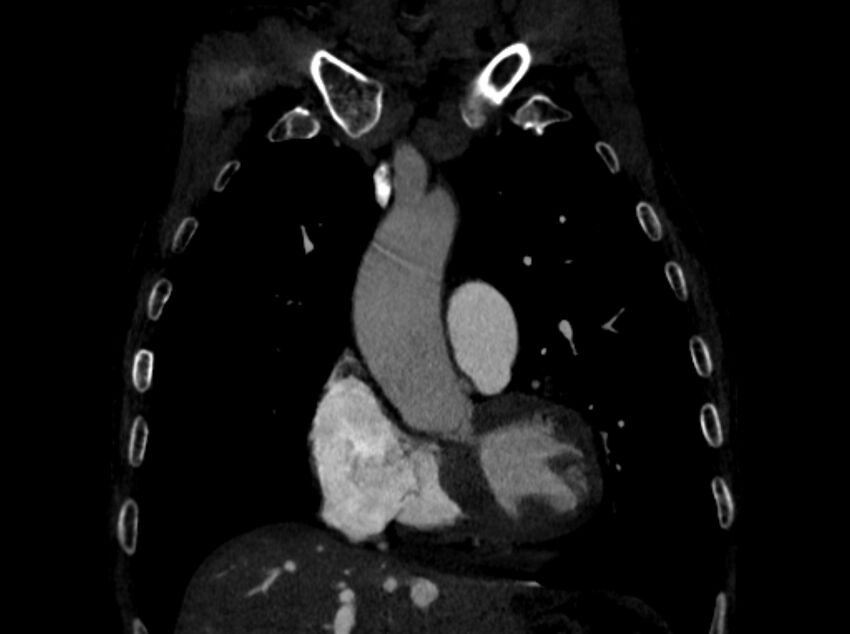 Chronic pulmonary embolism (Radiopaedia 91241-108843 A 29).jpg