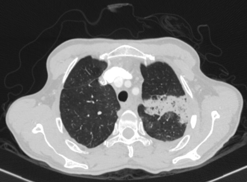 Chronic pulmonary embolism with bubbly consolidation (Radiopaedia 91248-108850 Axial lung window 31).jpg