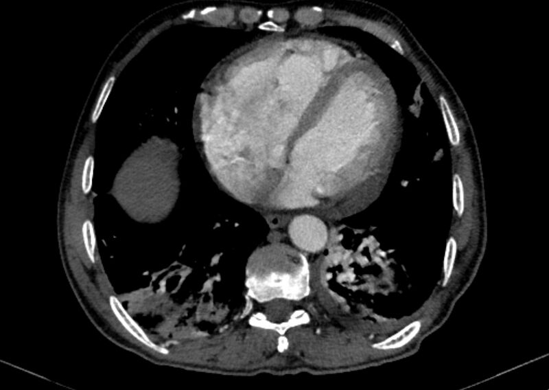 File:Chronic pulmonary embolism with bubbly consolidation (Radiopaedia 91248-108850 C+ arterial phase 109).jpg