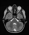 Chronic reactive multifocal osteomyelitis (CRMO) - mandible (Radiopaedia 56405-63069 Axial T2 24).jpg