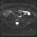 Class II Mullerian duct anomaly- unicornuate uterus with rudimentary horn and non-communicating cavity (Radiopaedia 39441-41755 Axial T2 fat sat 2).jpg