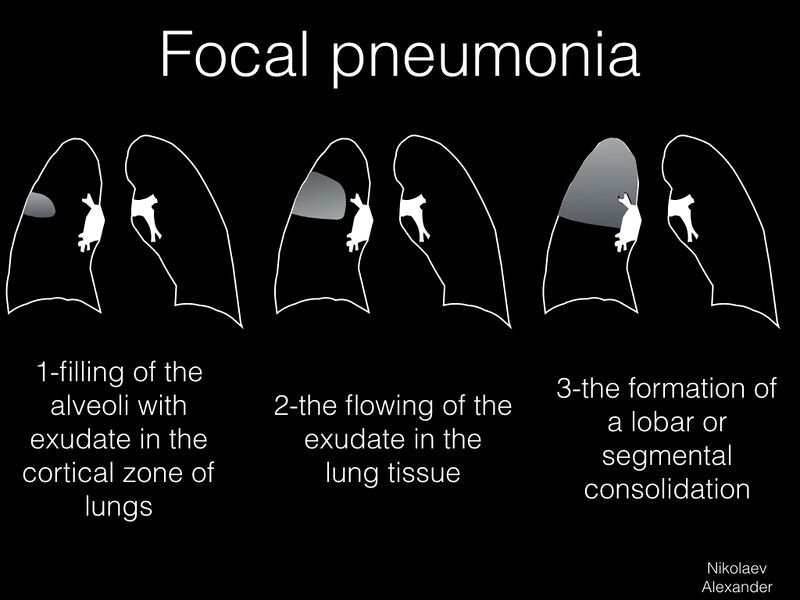 File:Classification of pneumonia (Radiopaedia 53288-59258 A 1).jpeg