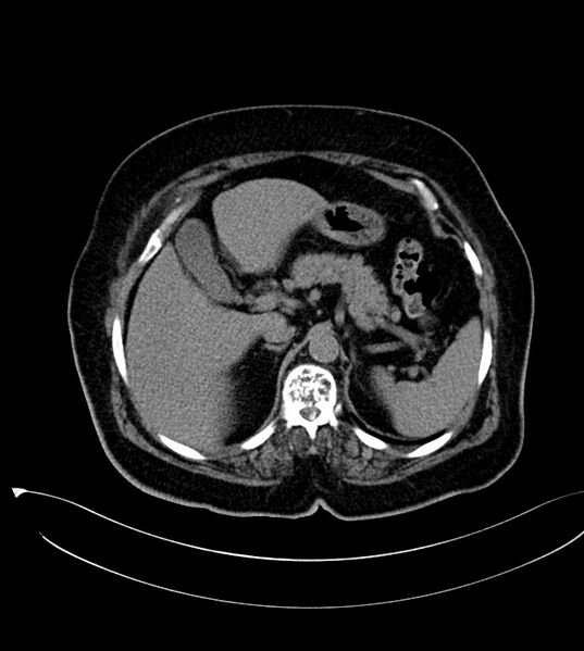 File:Clear cell renal cell carcinoma (Radiopaedia 85004-100537 Axial non-contrast 1).jpg