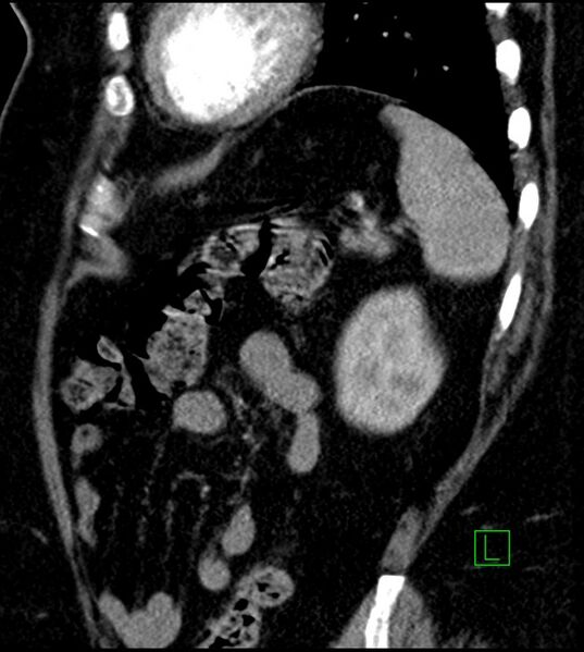 File:Clear cell renal cell carcinoma (Radiopaedia 85004-100537 D 15).jpg