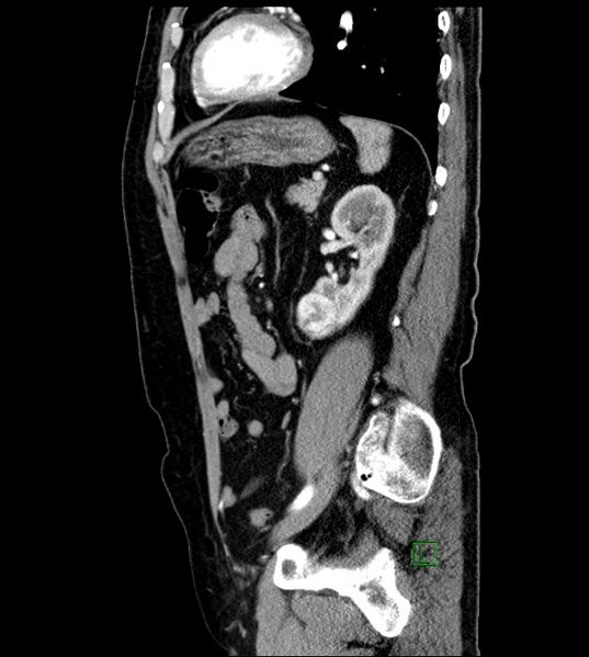 File:Clear cell renal cell carcinoma (Radiopaedia 85006-100539 E 19).jpg