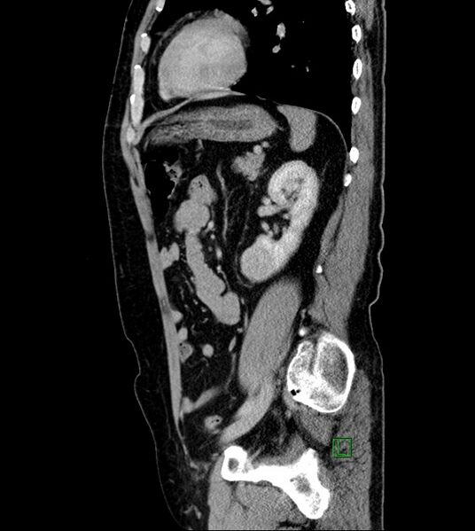File:Clear cell renal cell carcinoma (Radiopaedia 85006-100539 G 20).jpg