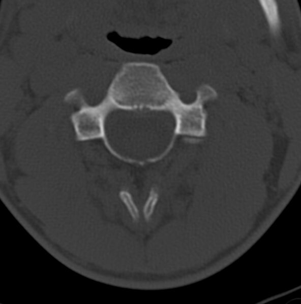 File:Cleft of the posterior arch of C1 mimicking fracture (Radiopaedia 40201-42721 Axial bone window 3).jpg