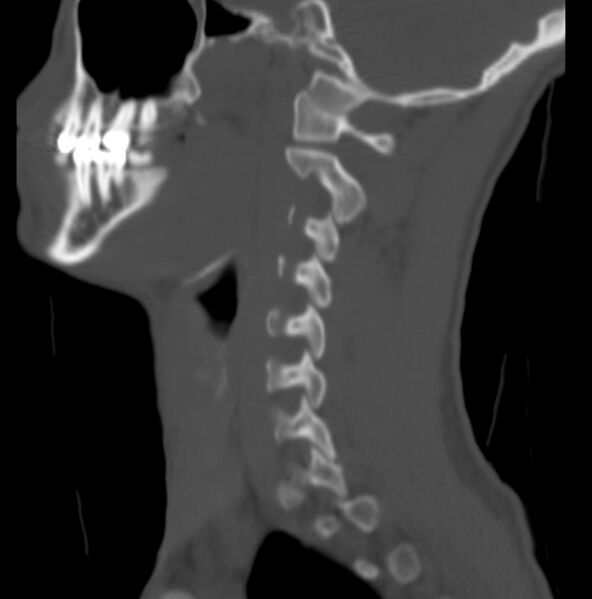 File:Cleft of the posterior arch of C1 mimicking fracture (Radiopaedia 40201-42721 Sagittal bone window 14).jpg