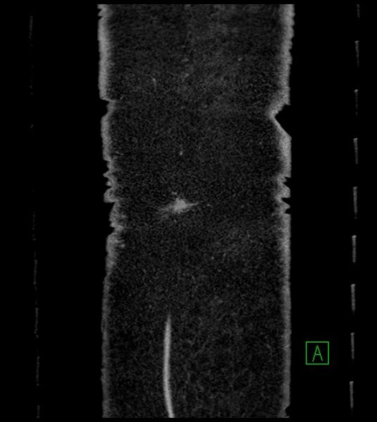File:Closed-loop small bowel obstruction-internal hernia (Radiopaedia 78439-91096 Coronal non-contrast 103).jpg