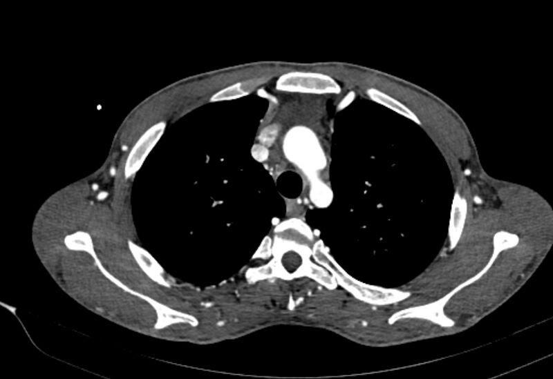 File:Coarctation of aorta with aortic valve stenosis (Radiopaedia 70463-80574 A 28).jpg