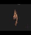 Coarctation of the aorta (Radiopaedia 43373-46729 3D reconstruction 15).jpg