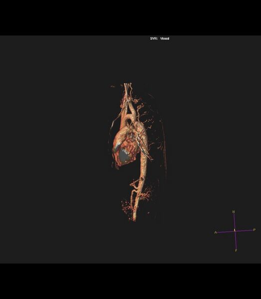 File:Coarctation of the aorta (Radiopaedia 43373-46729 3D reconstruction 15).jpg
