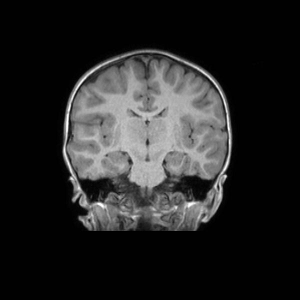 File:Cochlear nerve aplasia - unilateral (Radiopaedia 87910-104413 Coronal T1 29).jpg