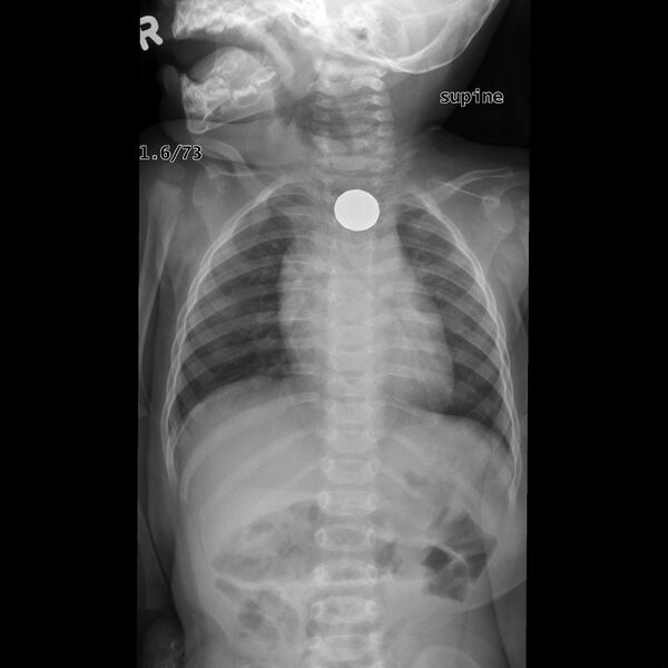 File:Coin in esophagus (Radiopaedia 7905-8747 Frontal 1).jpg