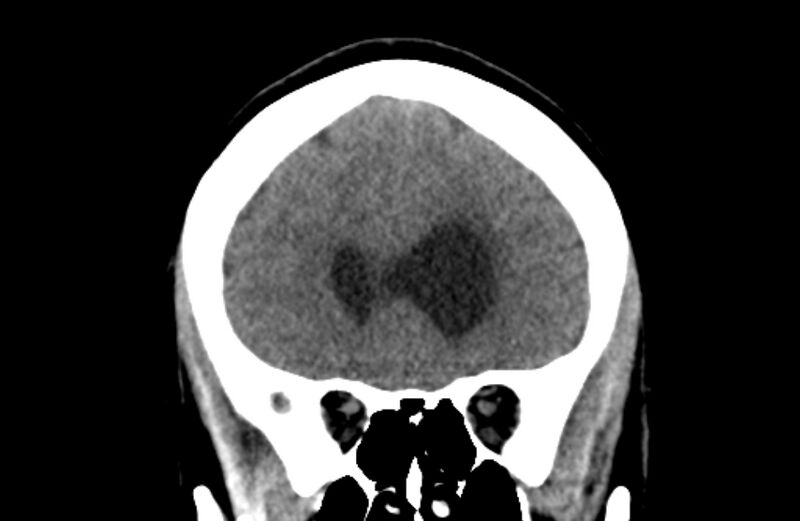 File:Colloid cyst (Radiopaedia 53180-59146 Coronal non-contrast 20).jpg