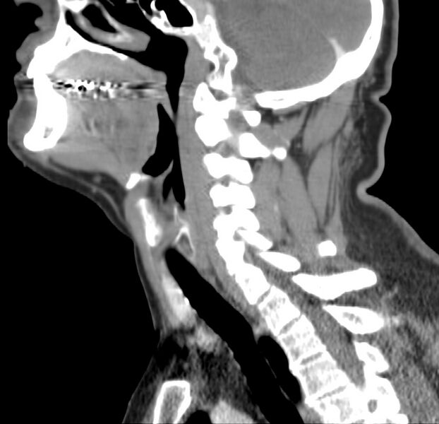 File:Colloid cyst of thyroid (Radiopaedia 22897-22923 Sagittal C+ delayed 27).jpg