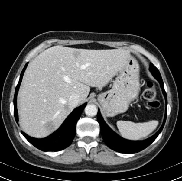 File:Colon carcinoma with hepatic metastases (Radiopaedia 29477-29961 A 19).jpg