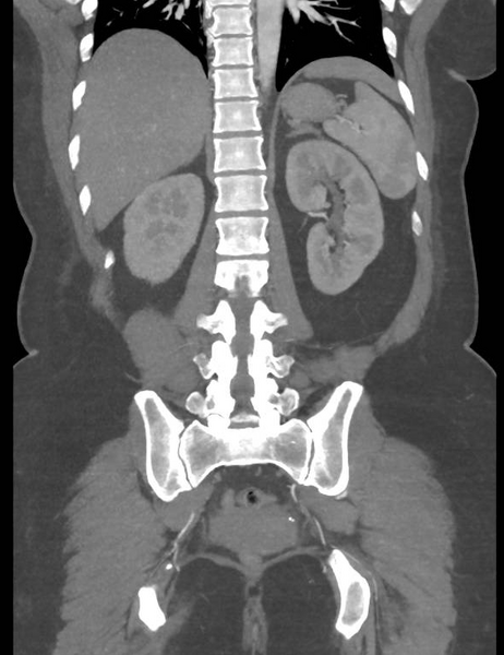 File:Colonic pseudo-obstruction (Radiopaedia 79752-92980 B 44).png