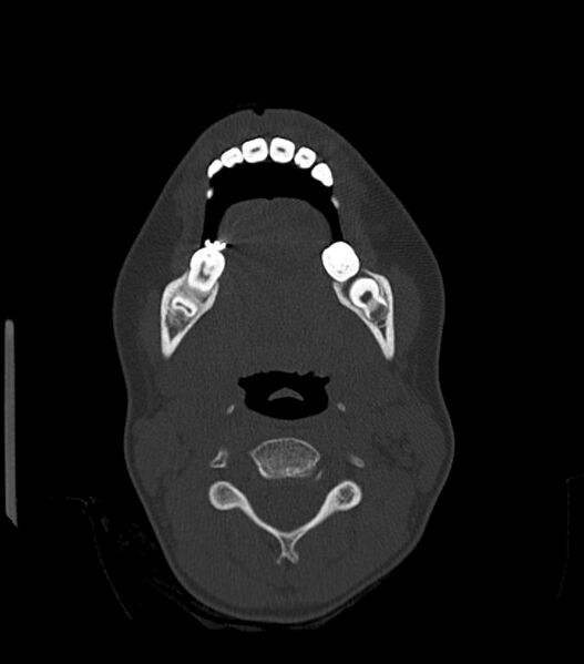 File:Nasoorbitoethmoid fracture (Radiopaedia 90044-107205 Axial bone window 35).jpg