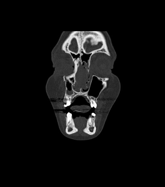 File:Nasoorbitoethmoid fracture (Radiopaedia 90044-107205 Coronal bone window 33).jpg