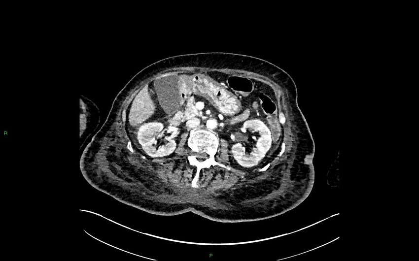 Neo-terminal ileal stricture (Crohn disease) (Radiopaedia 33790-34948 A 170).jpg