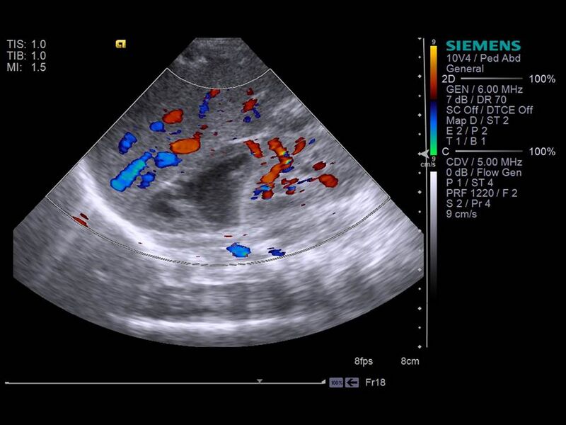 File:Neonatal adrenal hemorrhage (Radiopaedia 40215-42751 B 1).JPG