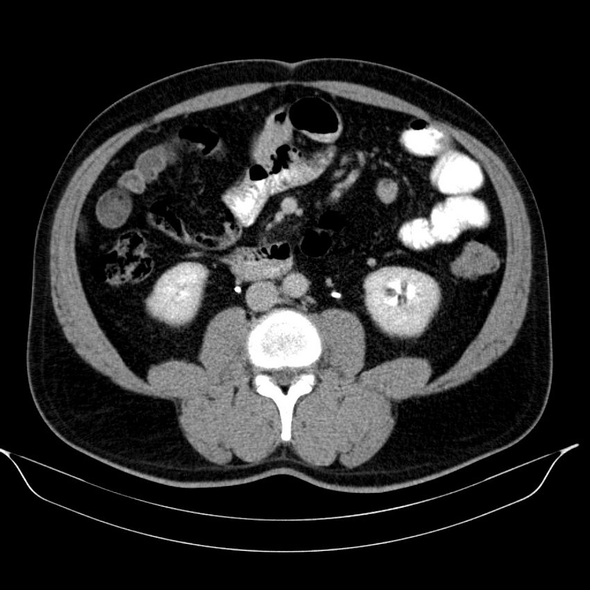 Neuroendocrine tumor of head of pancreas (Radiopaedia 57538-64502 D 45).jpg