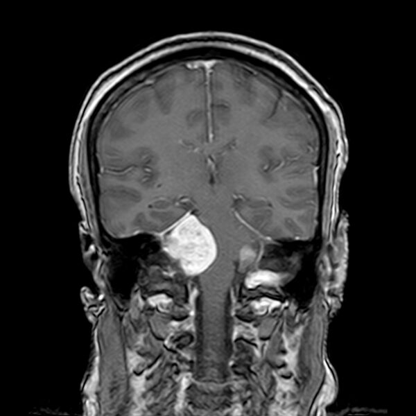File:Neurofibromatosis type 2 (Radiopaedia 67470-76871 Coronal T1 C+ 15).jpg