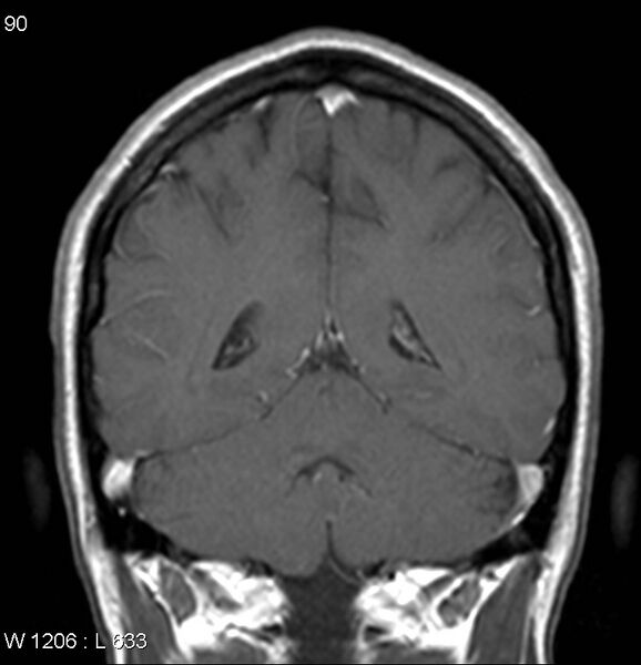 File:Neurosarcoidosis (Radiopaedia 10930-17204 Coronal T1 C+ 14).jpg