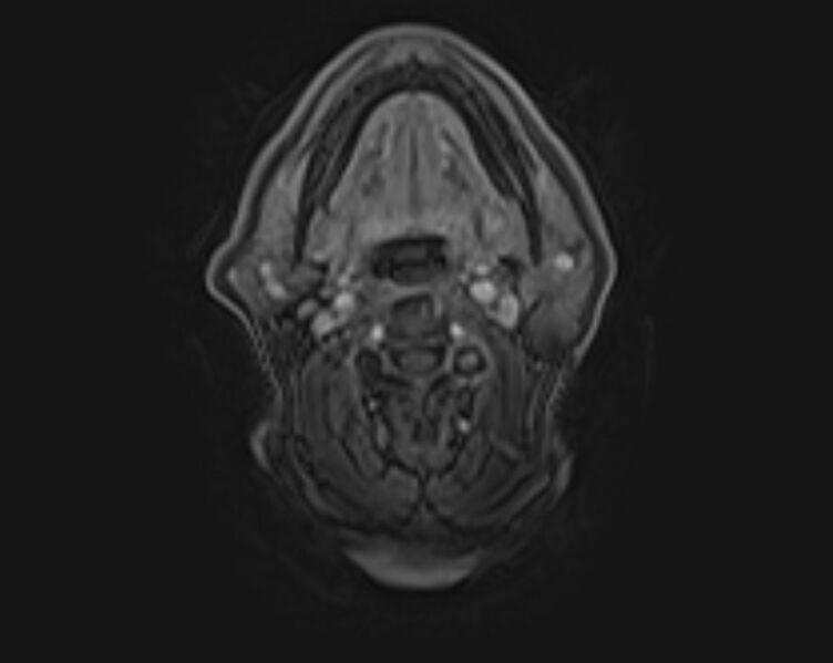 File:Non-Hodgkin lymphoma - parotid gland (Radiopaedia 71531-81890 E 32).jpg