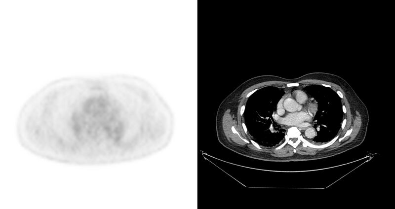 File:Non-Hodgkin lymphoma involving seminal vesicles with development of interstitial pneumonitis during Rituximab therapy (Radiopaedia 32703-33675 axial PET CT 46).jpg