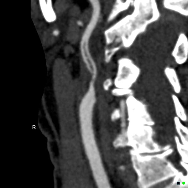 File:Non-occlusive intraluminal internal carotid artery thrombus (Radiopaedia 37751-39658 A 67).jpg