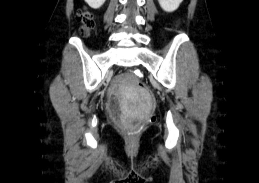 Non-puerperal uterine inversion (Radiopaedia 78343-91094 B 41).jpg